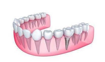 衡阳种植牙到底要多少钱？我就这告诉你
