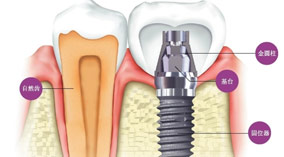 什么是种植牙？