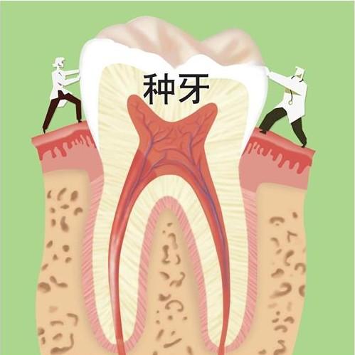 衡阳种植假牙多少钱一颗？