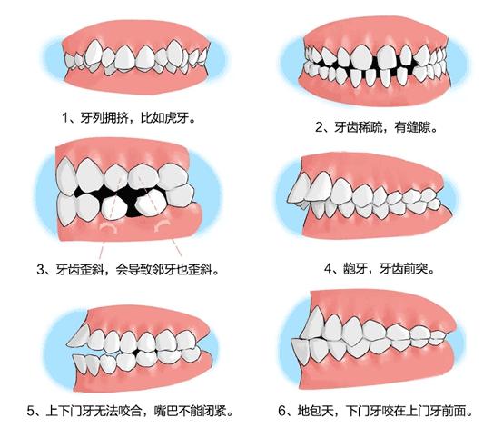 牙齿矫正有没有年龄限制