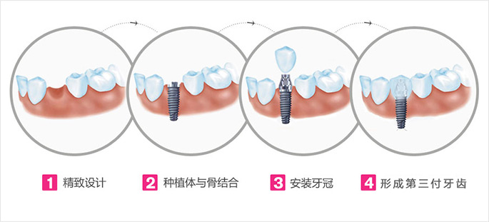 种植牙的优势及危害？(图2)